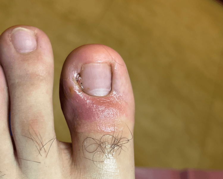 Onicocriptosis un lateral