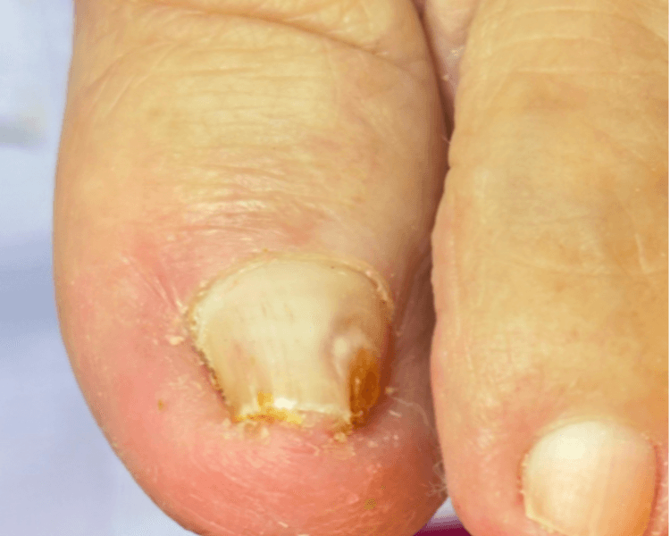 Reconstrucción ungueal