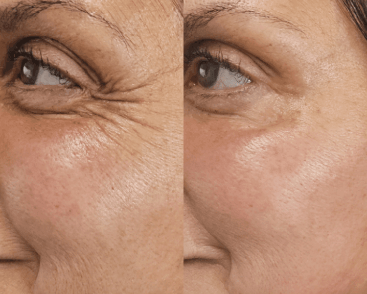 Toxina botulinica 1 zona (efectivo/transferencia)