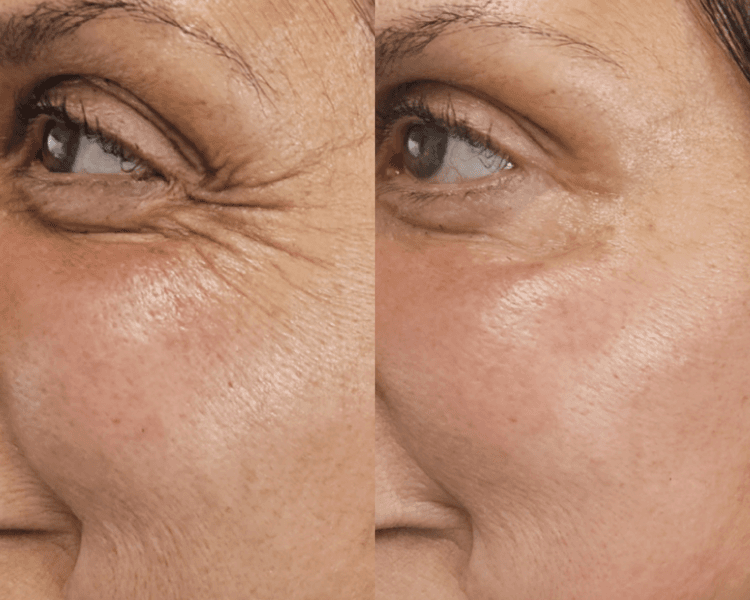 Toxina botulinica 1 zona (3 cuotas sin interes)