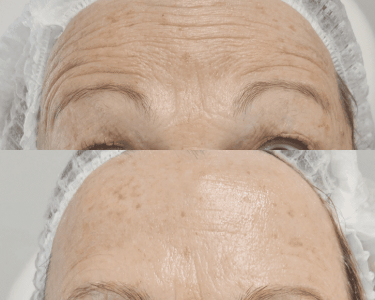 Toxina botulinica 2 zonas (efectivo/transferencia)