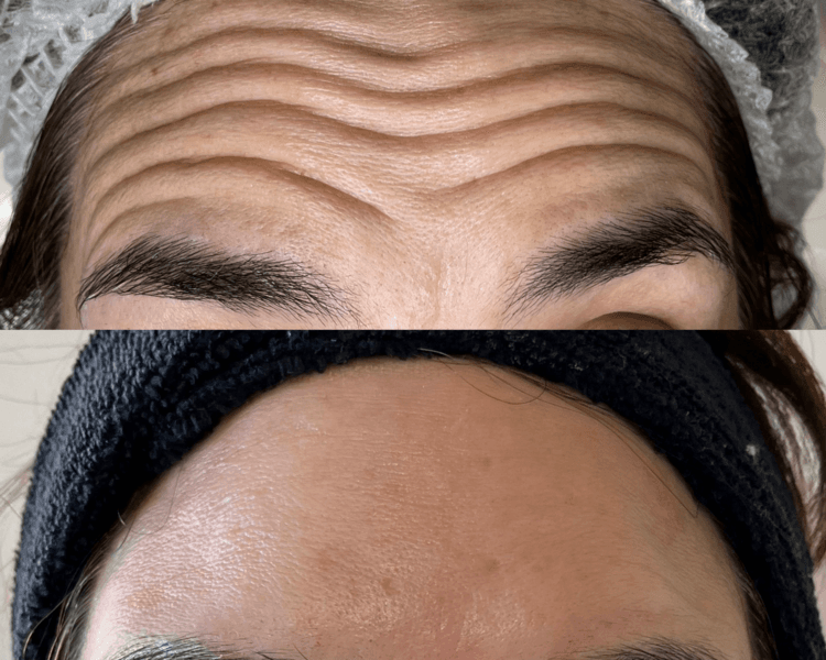 Toxina botulinica 3 zonas (efectivo/transferencia)