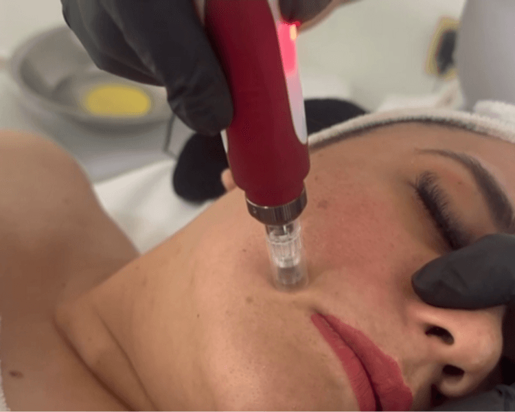 MICROPUNCION DERMAPEN TX PIEL MADURA