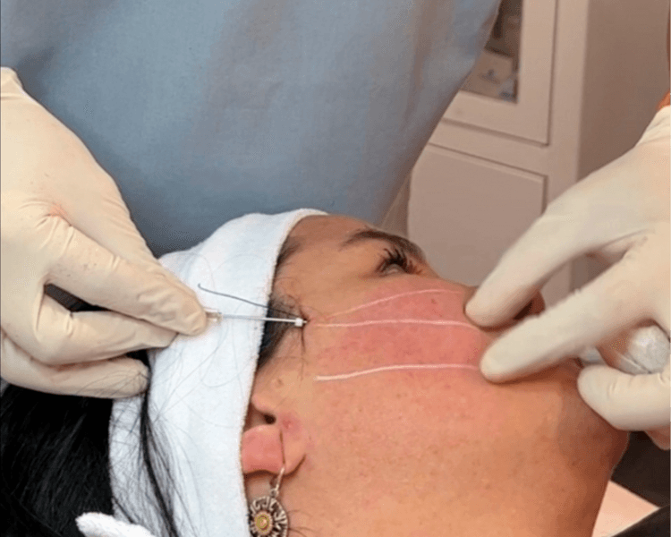 APLICACION DE HILOS TENSORES DE COLAGENO TOPICOS