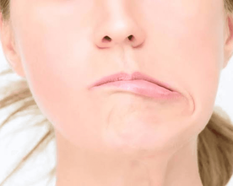 Recuperacion parálisis facial 10 sesiones