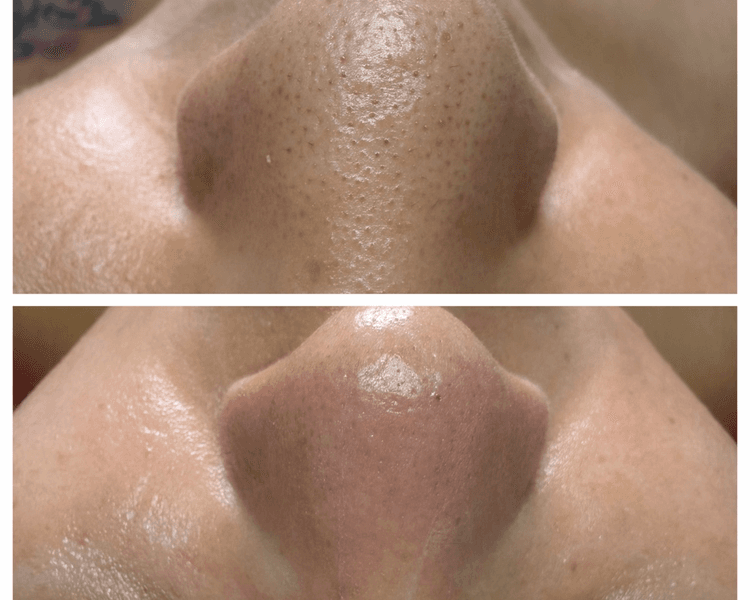 LIMPIEZA FACIAL PROFUNDA E HIDRATACION