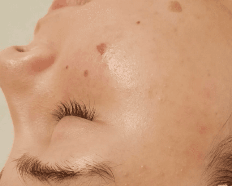 Programa Método MapDerma - Equilibrio Cutáneo. 4 sesiones