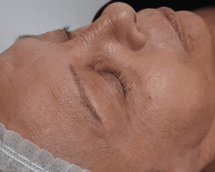 Programa método MapDerma - Rejuvenecimiento & Firmeza. 4 sesiones