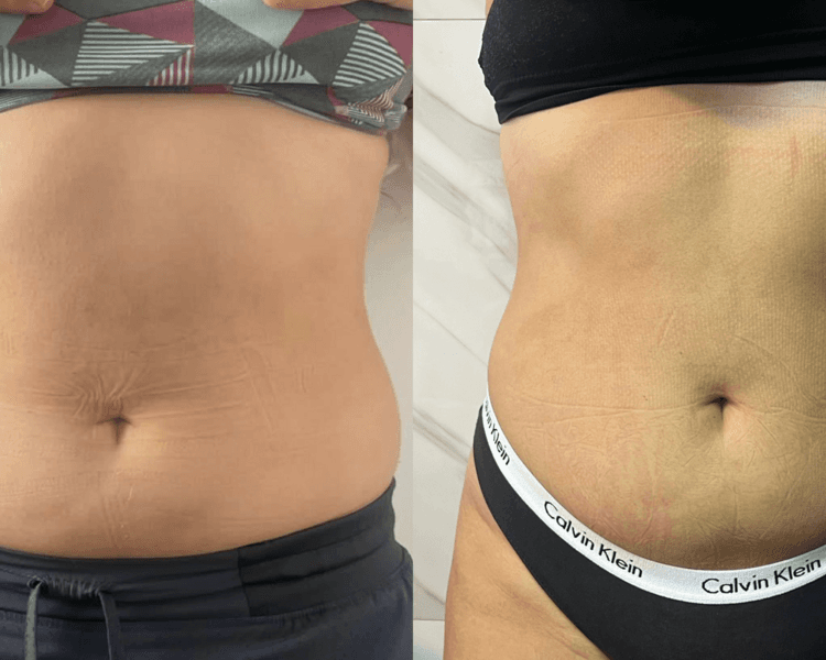 Lipoescultura sin cirugía abdomen + espalda 8 sesiones