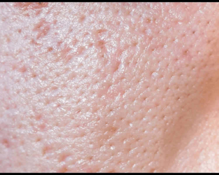 MICRODERMOABRASION RENOVACION DE CELULA IDEAL PARA SECUELA DE ACNE