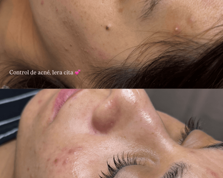 Control de acné