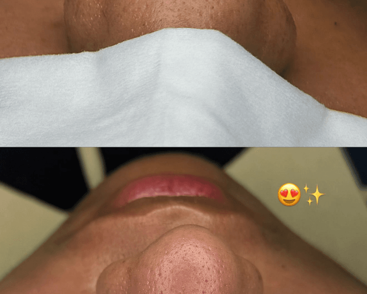 Purificación Profunda