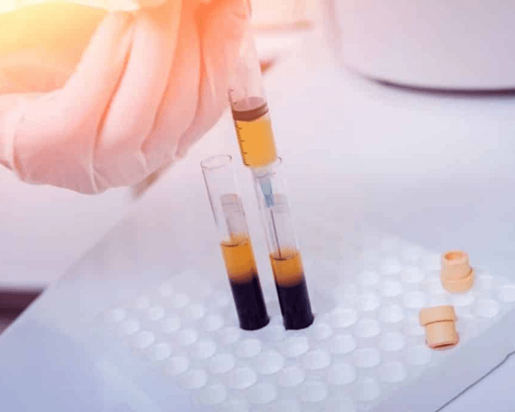 PLASMA RICO EN PLAQUETAS (PRP) FACIAL