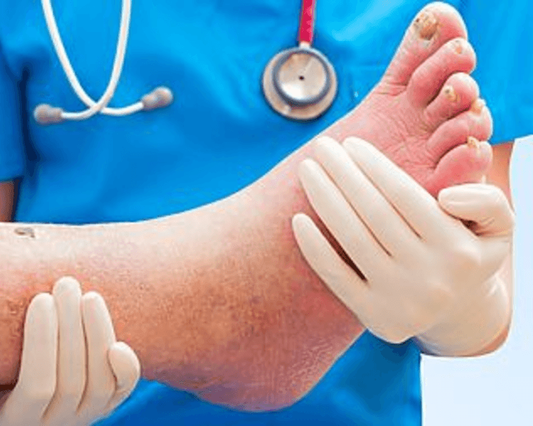 Curación de Pie Diabético