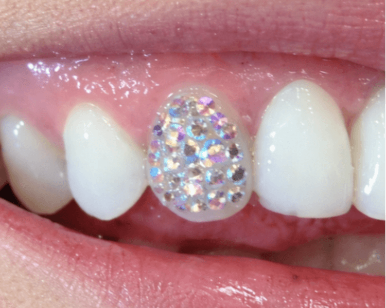 Diseño Diente Completo