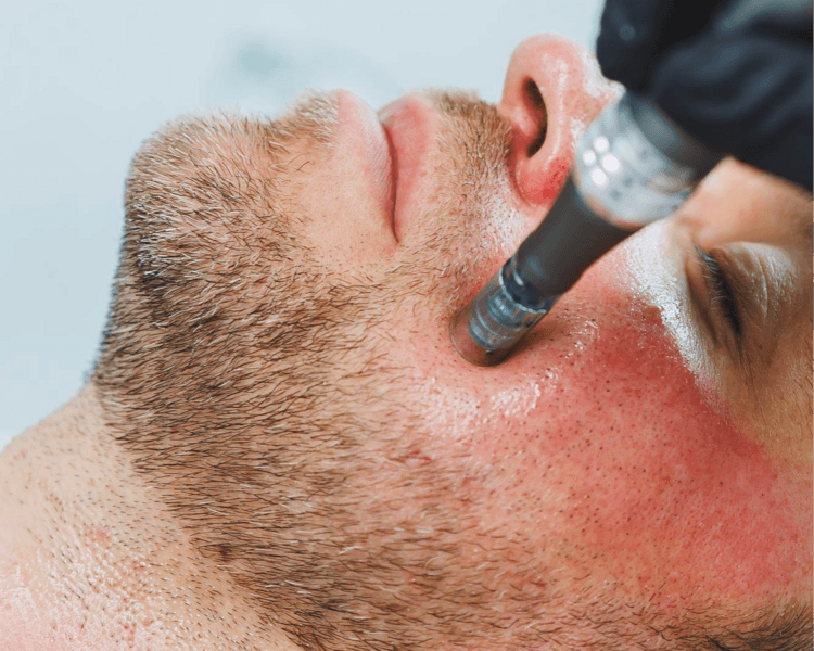 Mesoterapia para barba