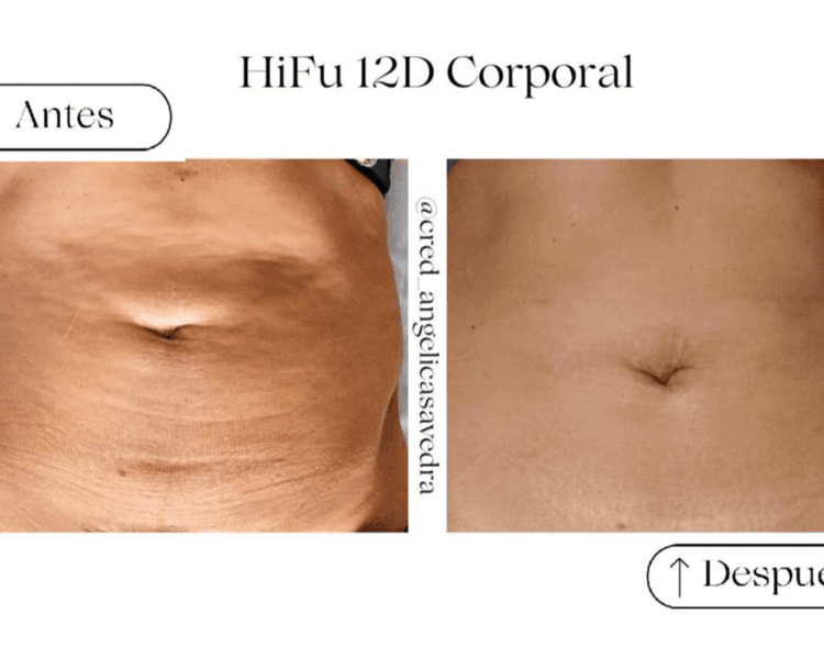 Hi Fu Corporal (por zona)