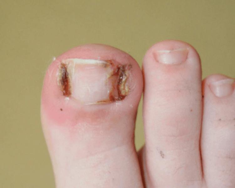 Uña Encarnada Bilateral (por uña)