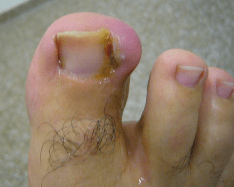 Uña Encarnada Unilateral (por uña)