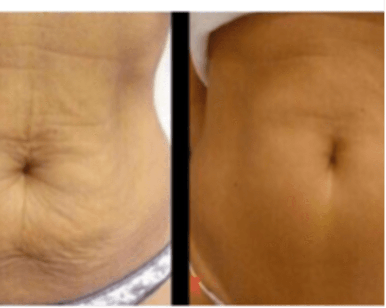 Hifu Abdomen mas Cintura