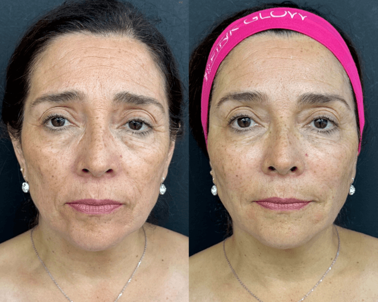 Bioestimulación híbrida (lenisna o juvelook) con mesoterapia (pinkglow o nctf135)