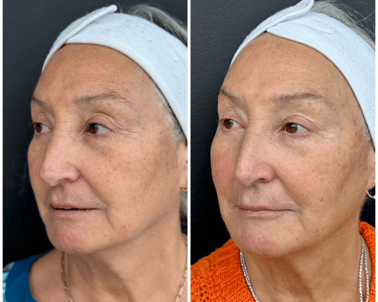 P. facial 2 o Leve (Hydrafacial signature + 50U Toxina botulínica + 2 Ac. Hialurónico + 1 Estimulador de colágeno + 1 sesión PBL ó Mc/RF)