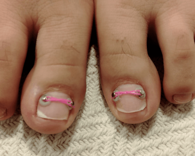 Ortonixia de las Uñas (por uña)