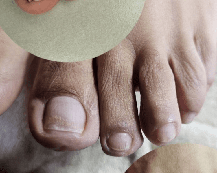 Tratamiento hongos más servicio Podológico jjvv