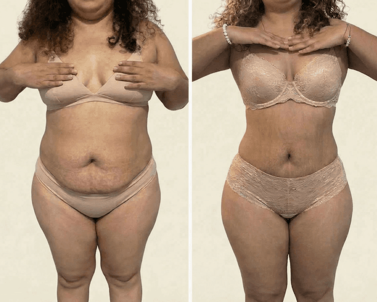 Melia GOLD🌟 Body Sculpting