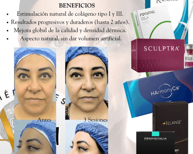 Bioestimulador Radiesse