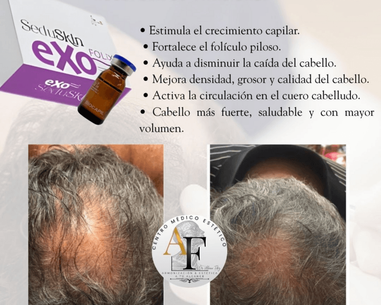 Tratamiento capilar (mesoterapia)