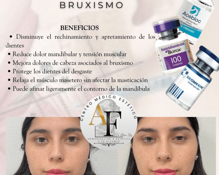 Toxina botulínica en maseteros (Bruxismo)