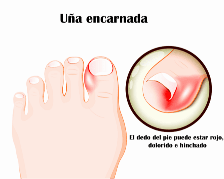 Uña enterrada