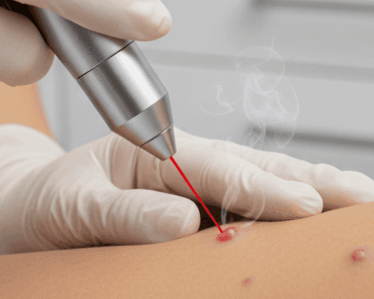 Cauterización Verrugas (eliminacion de verruga común)