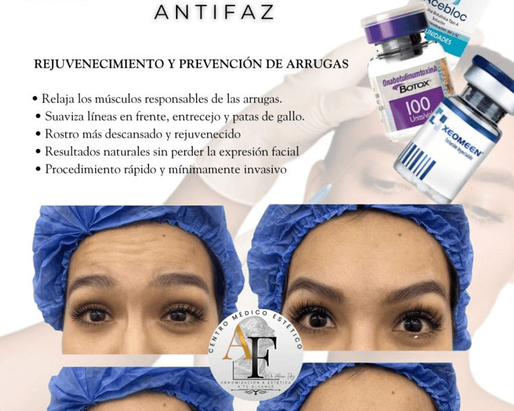 Toxina botulínica en zona de antifaz