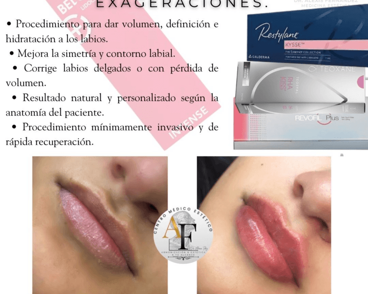 Relleno de labios con Acido hialuronico