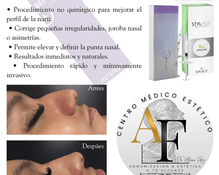 Rinomodelación con Acido hialuronico