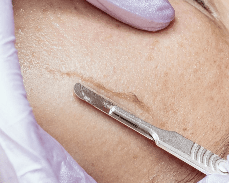 Facial dermaplaning