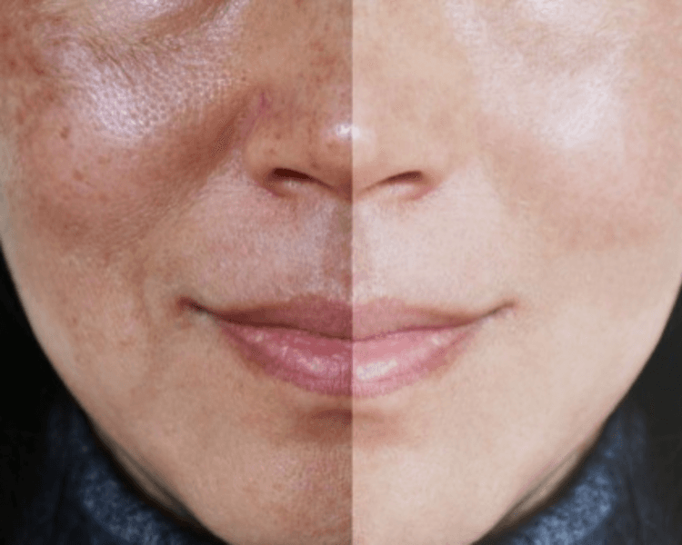 Limpieza Facial + Despigmentacion