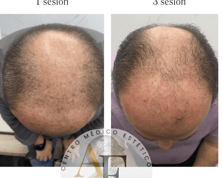 Tratamiento capilar (mesoterapia)