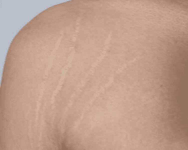 Tratamiento para Estrias