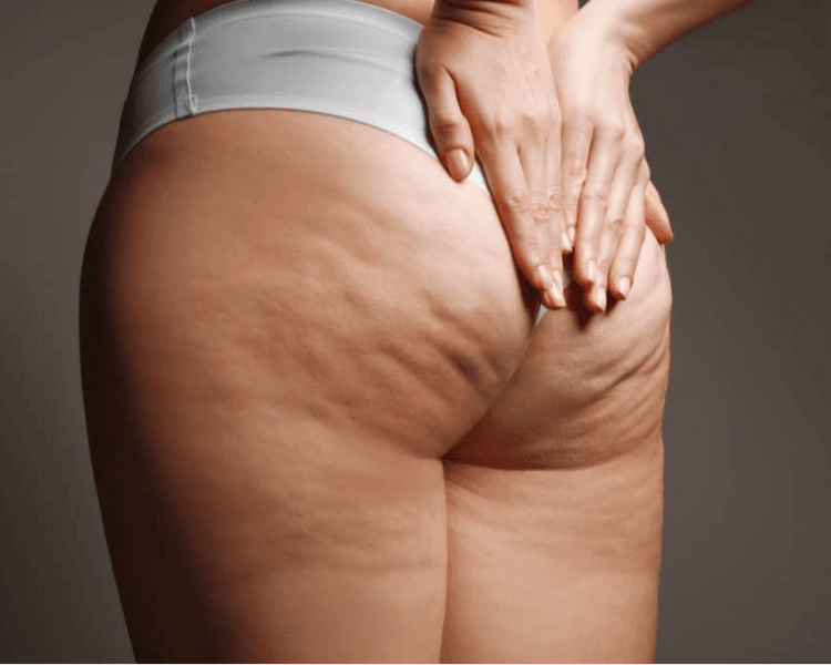 Tratamiento Anticelulitico