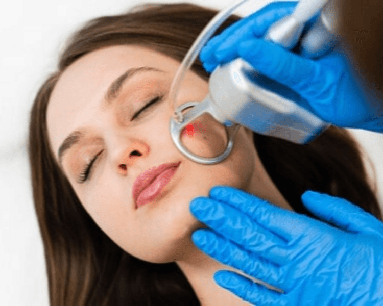 Laser Co2 Fraccionado 1 Zona