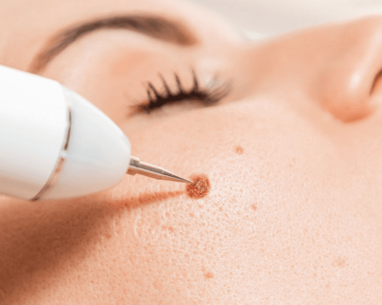 Retiro de Verrugas y Lunares