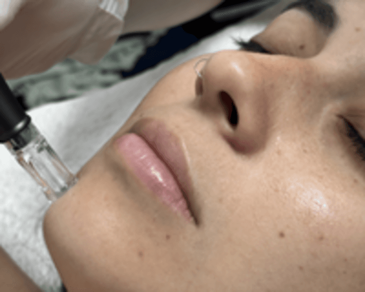 Golden Glow | Dermapen