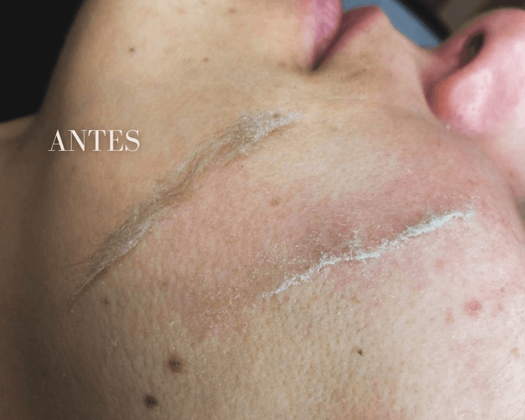 Full Dermaplaning + Alta frecuencia.