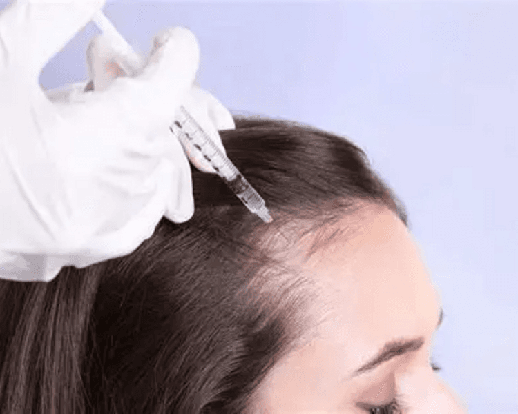 Mesoterapia Capilar