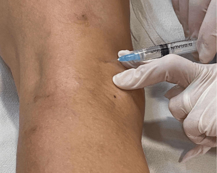 Tratamiento esclerosante