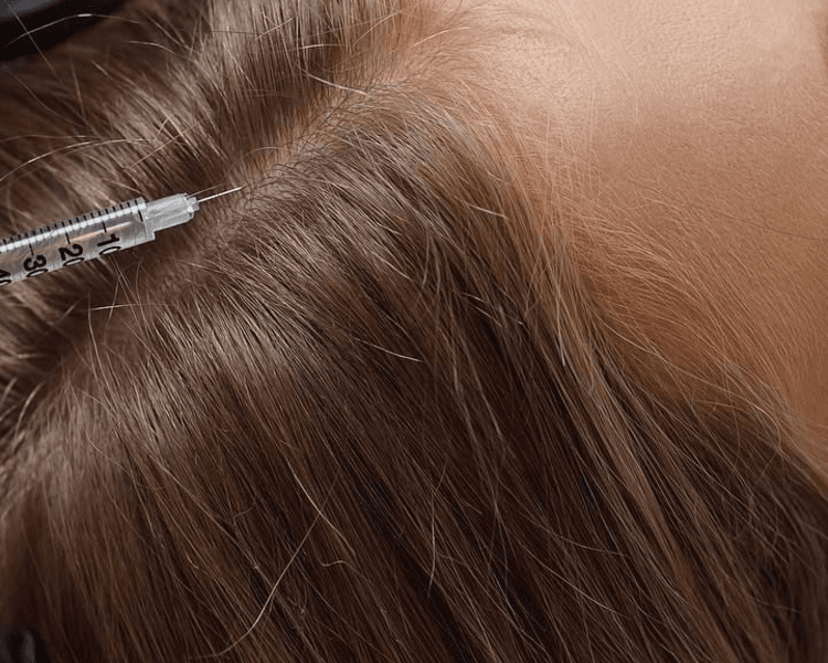 Mesoterapia - Capilar