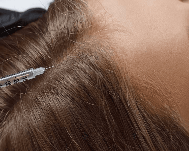 Pack de 4 sesiones - Mesoterapia Capilar